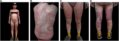 Case report: Successful treatment of acute generalized pustular psoriasis of puerperium with secukinumab